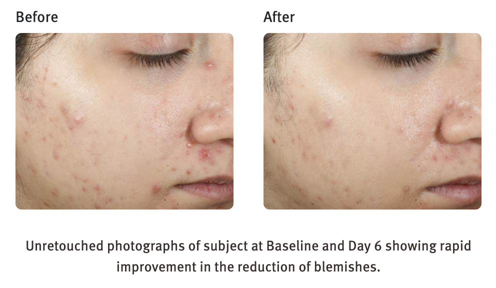 Skinship | Epionce Purifying Spot Gel | Atlanta Skincare and
